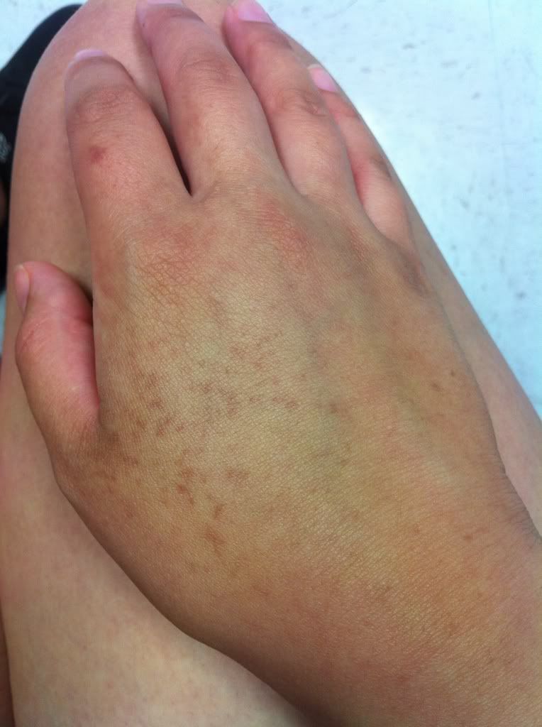 brown-spots-on-hands-babycenter